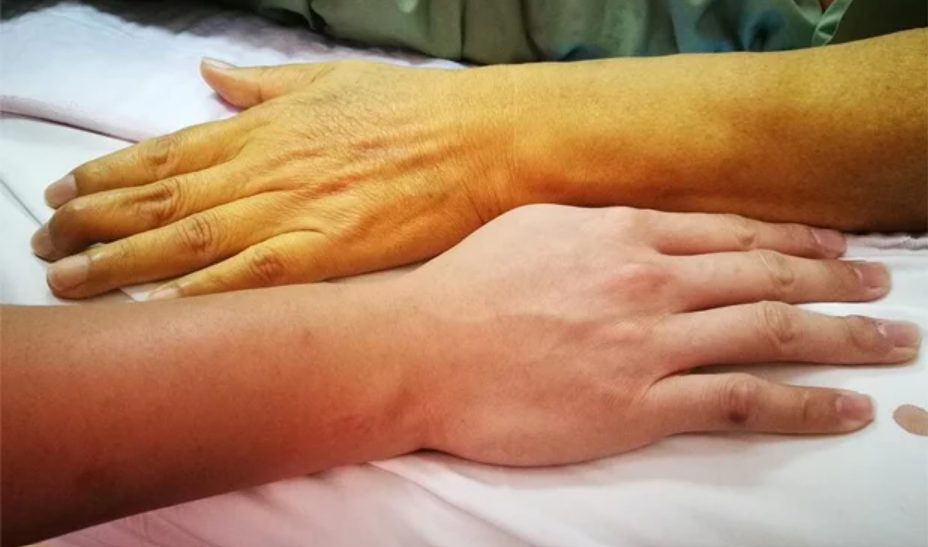 comparación de mano sana con mano con bilirrubina alta